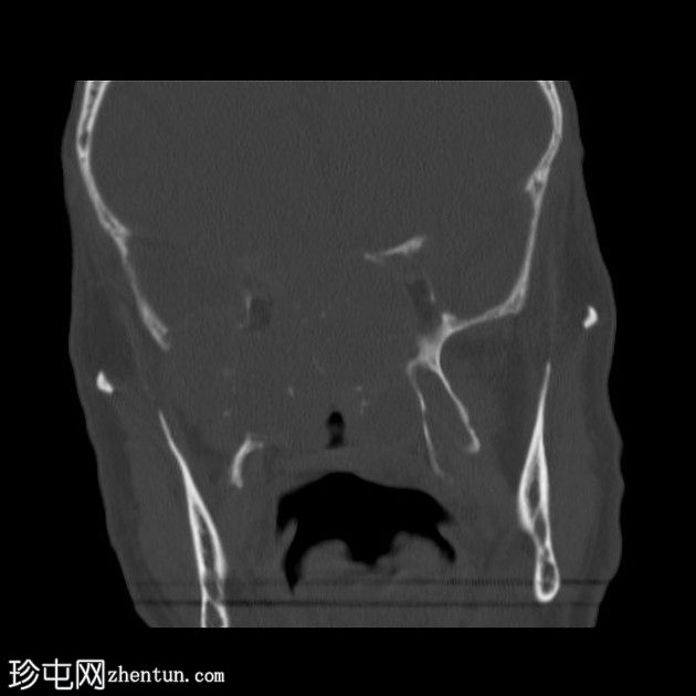 鼻窦骨化性纤维黏液样肿瘤