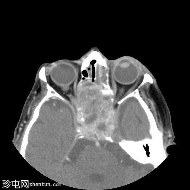 鼻窦骨化性纤维黏液样肿瘤