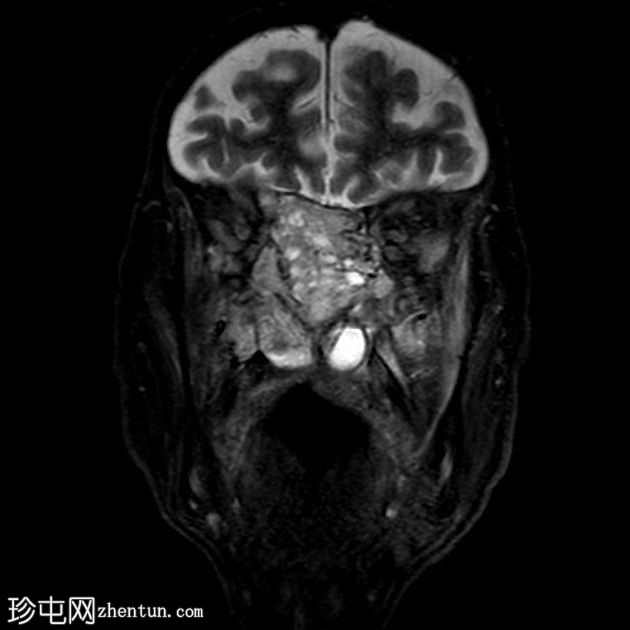 鼻窦骨化性纤维黏液样肿瘤