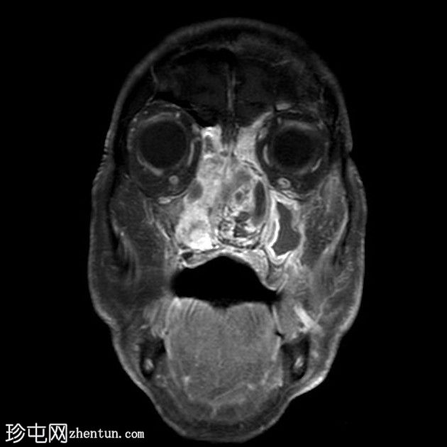 鼻窦骨化性纤维黏液样肿瘤