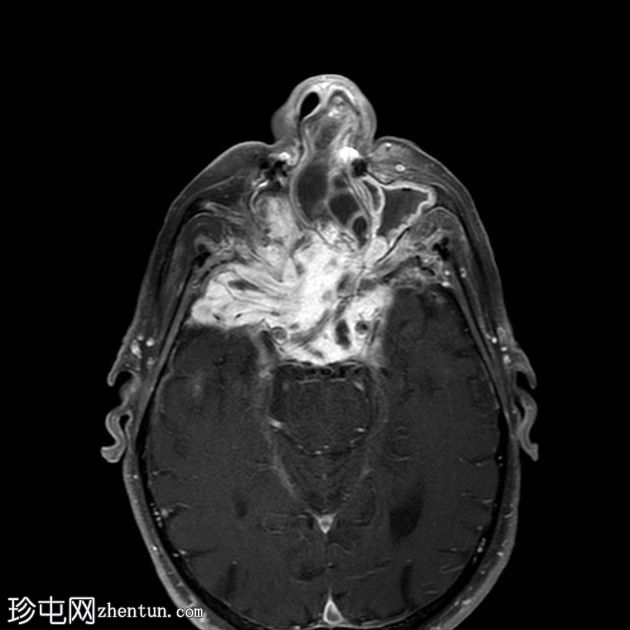 鼻窦骨化性纤维黏液样肿瘤