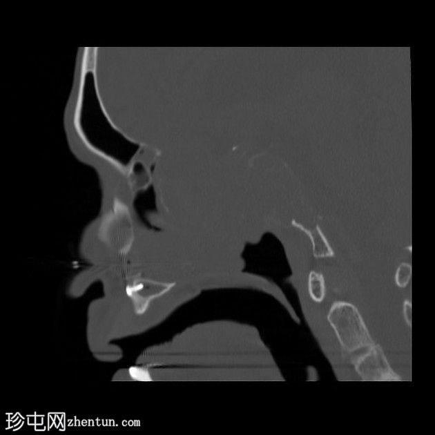 鼻窦骨化性纤维黏液样肿瘤