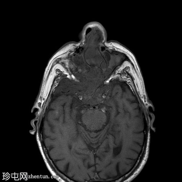 鼻窦骨化性纤维黏液样肿瘤