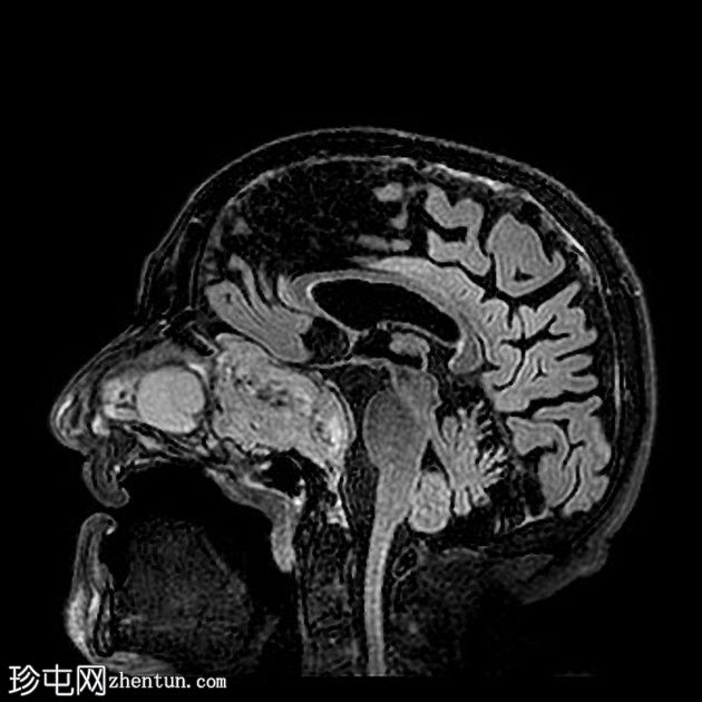 鼻窦骨化性纤维黏液样肿瘤