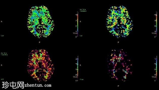 硬膜下出血CT灌注
