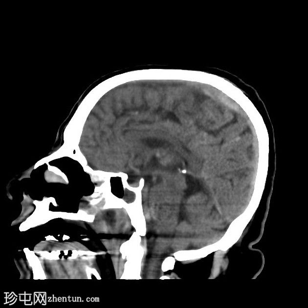 急性上矢状窦血栓形成