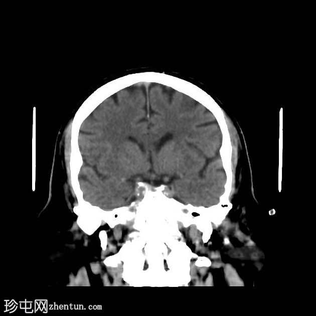 急性上矢状窦血栓形成