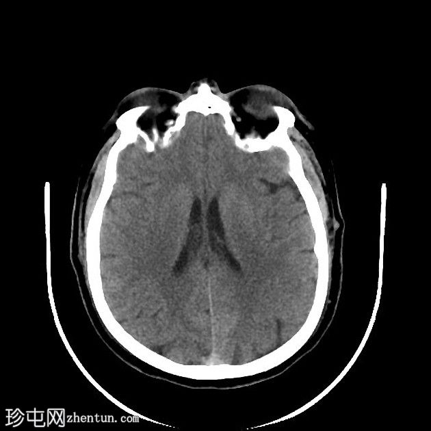 急性上矢状窦血栓形成