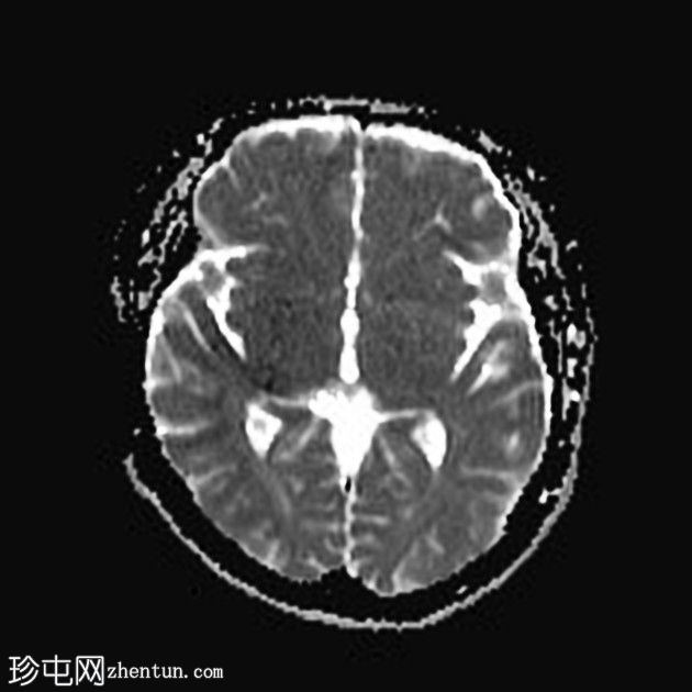 急性上矢状窦血栓形成