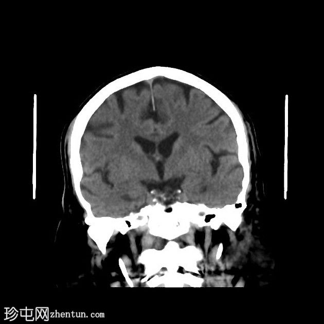 急性上矢状窦血栓形成