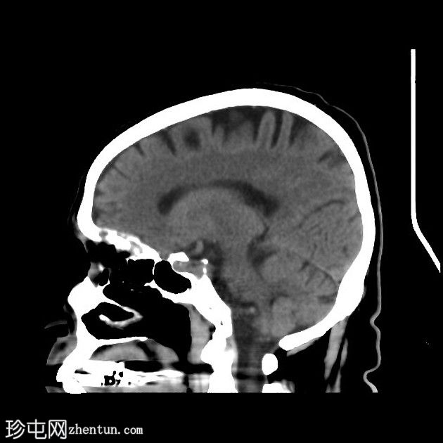 急性上矢状窦血栓形成