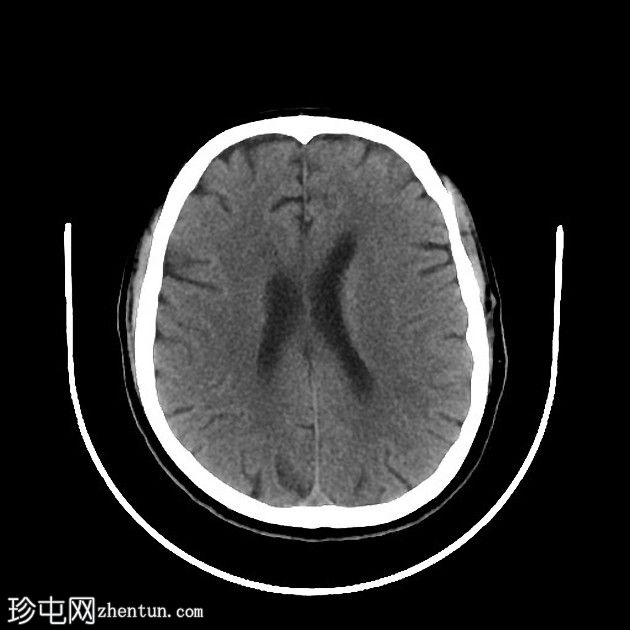 急性上矢状窦血栓形成