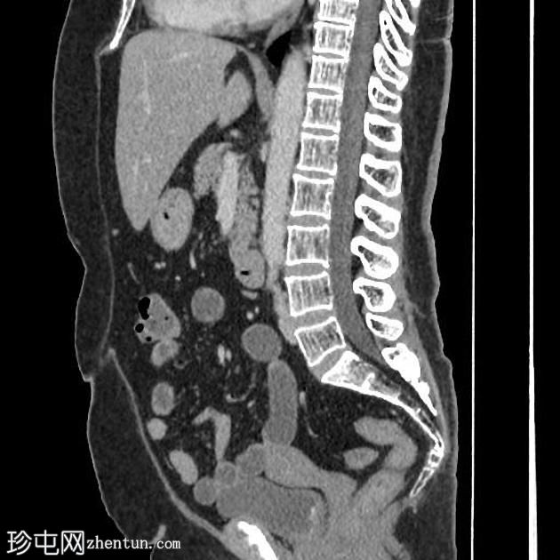 膀胱平滑肌瘤