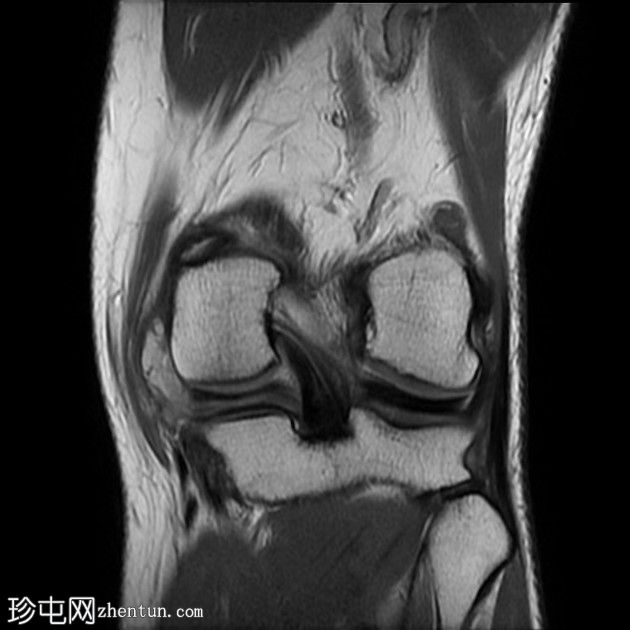 水平半月板撕裂伴半月板大囊肿