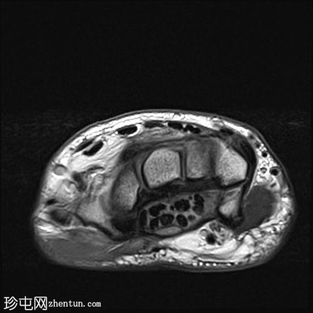 腕管综合症