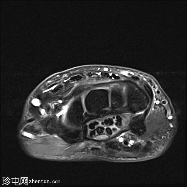 腕管综合症