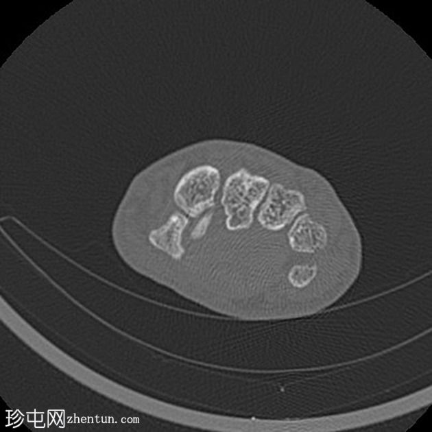 经舟骨月骨周围脱位