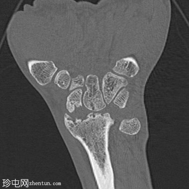 经舟骨月骨周围脱位