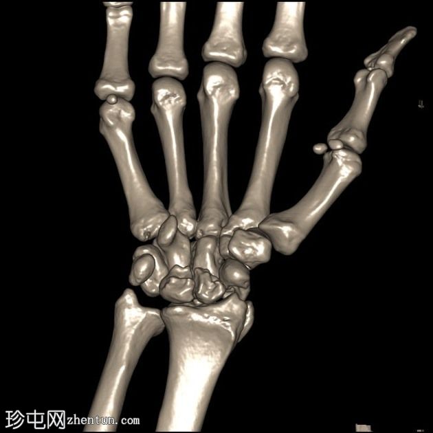 经舟骨月骨周围脱位