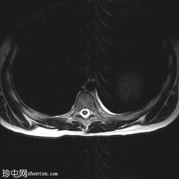 丛状神经纤维瘤