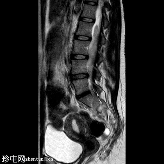 丛状神经纤维瘤的恶性转化