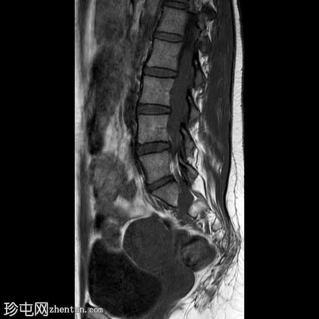 丛状神经纤维瘤的恶性转化