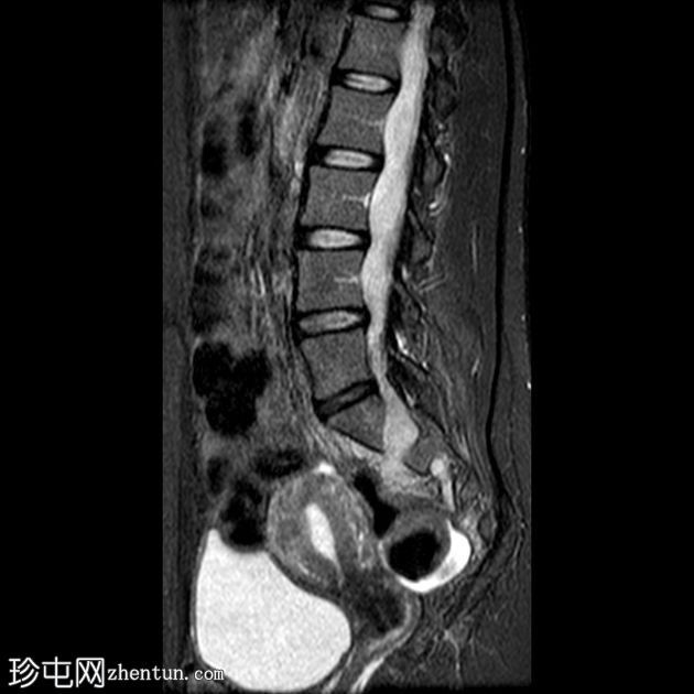 丛状神经纤维瘤的恶性转化