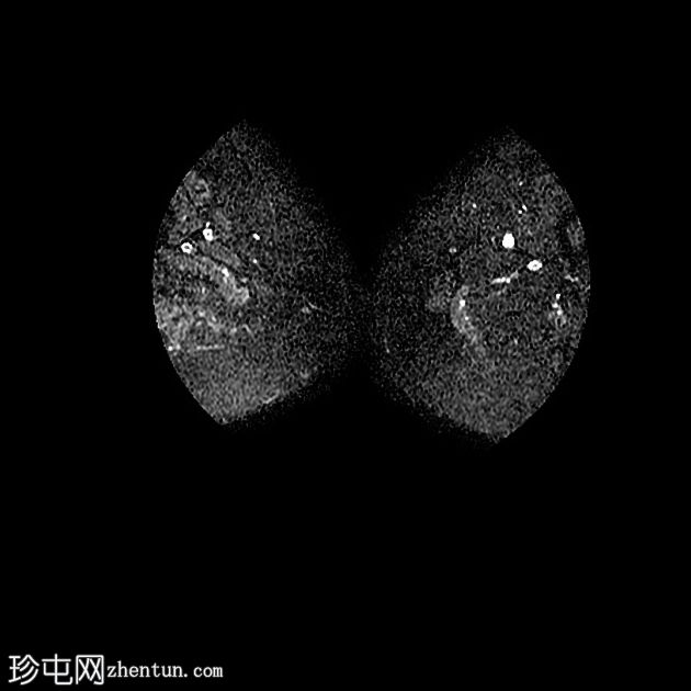 丛状神经纤维瘤的恶性转化