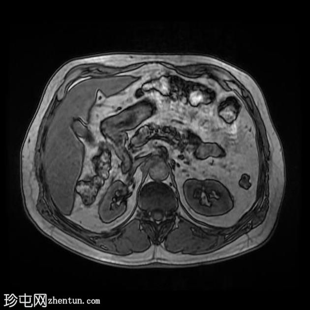 肾上腺腺瘤