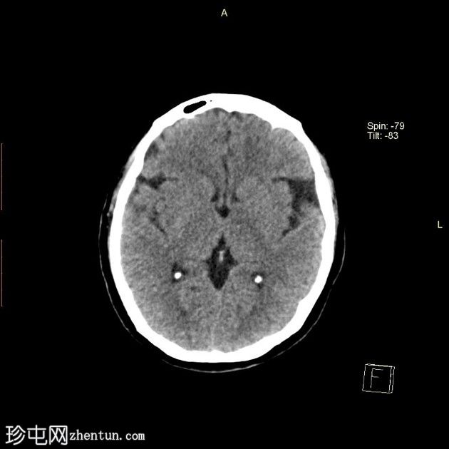 鼻窦粘膜黑色素瘤