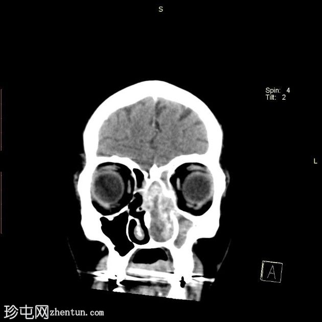 鼻窦粘膜黑色素瘤