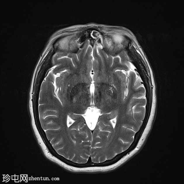 鼻窦粘膜黑色素瘤