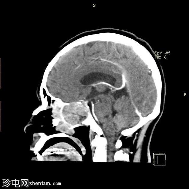 鼻窦粘膜黑色素瘤