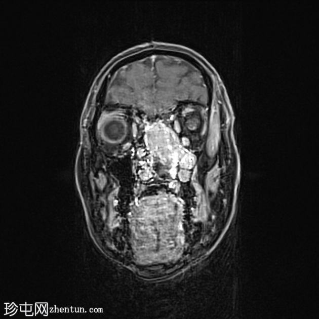 鼻窦粘膜黑色素瘤