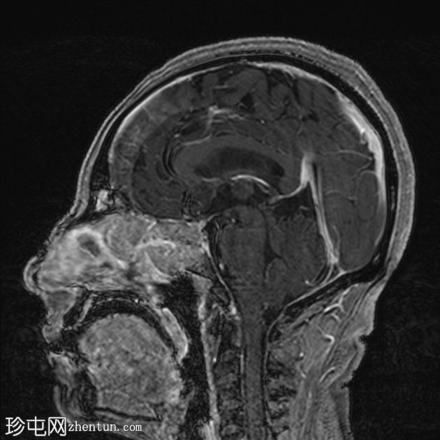 鼻窦粘膜黑色素瘤