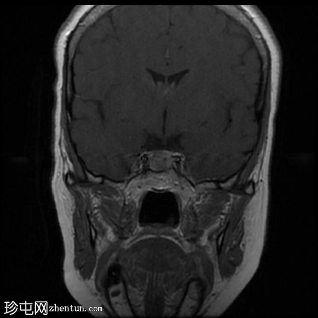 垂体大腺瘤