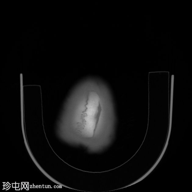 标志性颅骨骨折