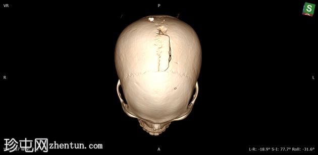 标志性颅骨骨折