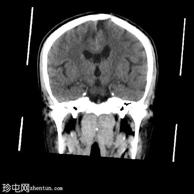 标志性颅骨骨折