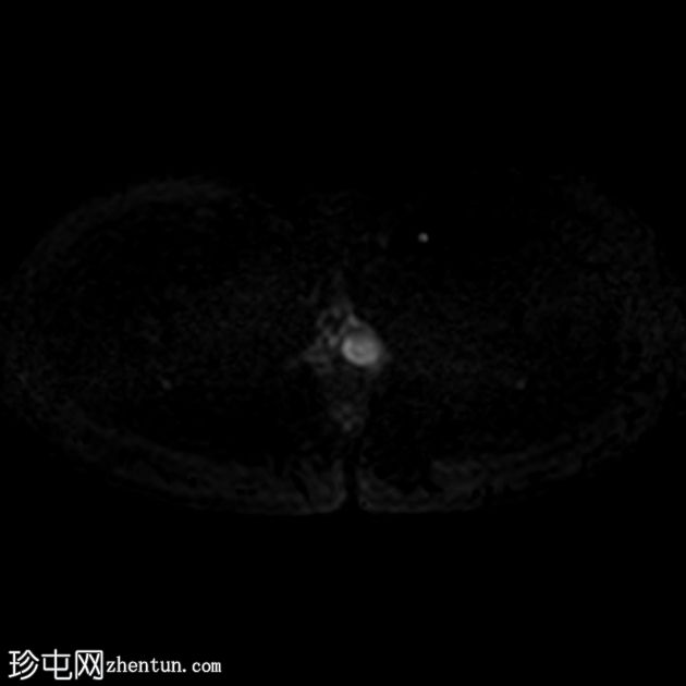 前庭大腺囊肿