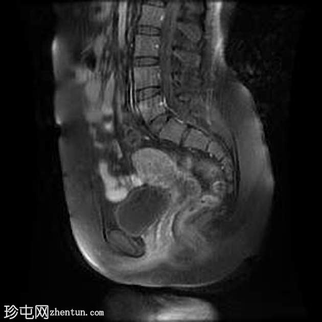 子宫内膜瘤- T2阴影征