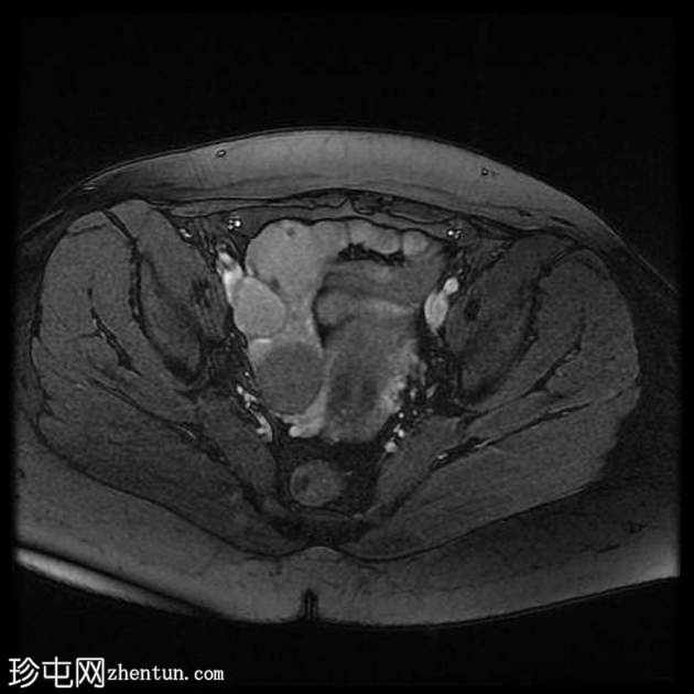 子宫内膜瘤- T2阴影征