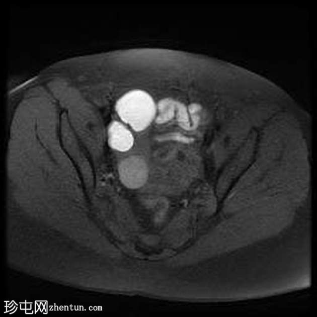 子宫内膜瘤- T2阴影征