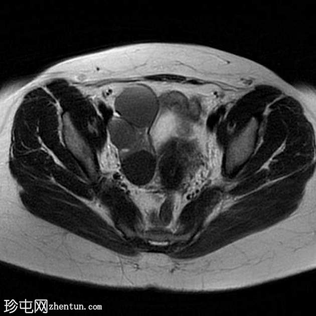 子宫内膜瘤- T2阴影征