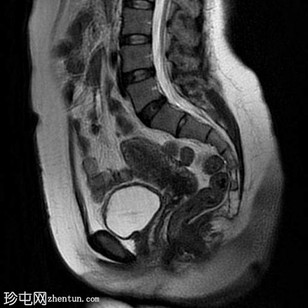 子宫内膜瘤- T2阴影征