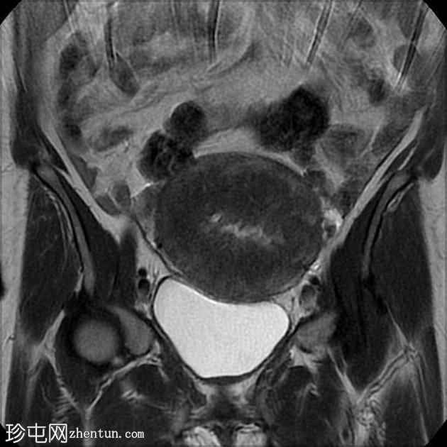 弥漫性子宫腺肌病