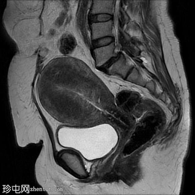 弥漫性子宫腺肌病