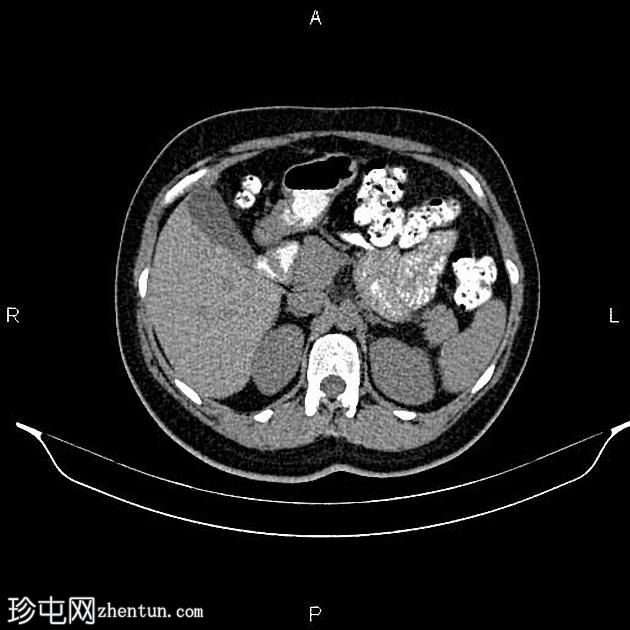 卵巢浆液性囊腺瘤