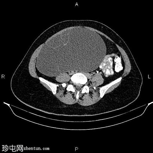 卵巢浆液性囊腺瘤