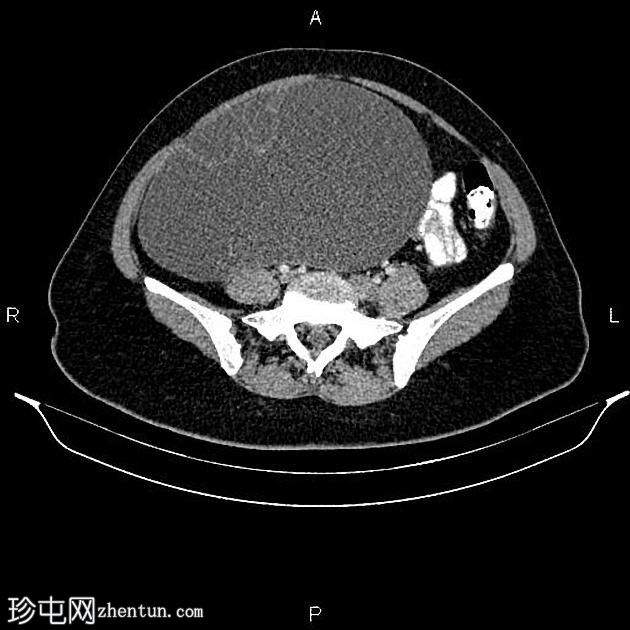 卵巢浆液性囊腺瘤